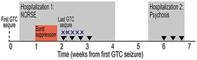 Role of responsive neurostimulation and immunotherapy in refractory epilepsy due to autoimmune encephalitis: A case report